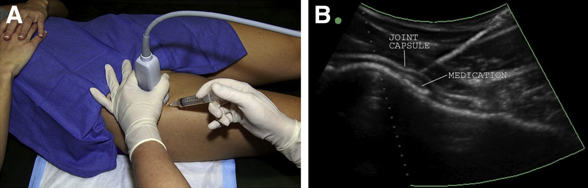 Hip Aspiration Technique Procedures Healthbeauty Your Health